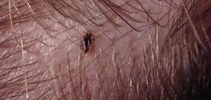 طرق القضاء على القمل وبيضه