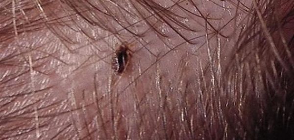 طرق القضاء على القمل وبيضه
