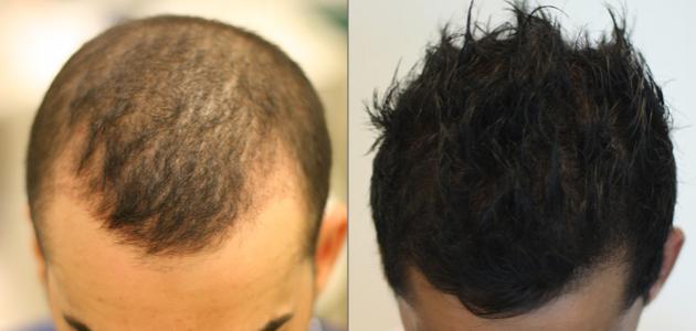 كيف تتم عملية زراعة الشعر