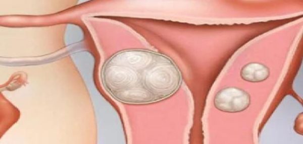 علاج_تليف_الرحم