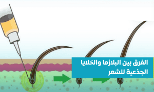 البلازما-والخلايا-الجذعية-للشعر