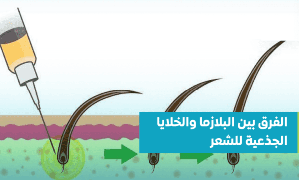البلازما-والخلايا-الجذعية-للشعر